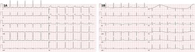 Case Report: Pulsed field ablation for epicardial right-sided accessory pathway
